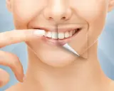 Ile kosztuje Hollywood Smile: kompletny cennik zabiegów w 2025 roku